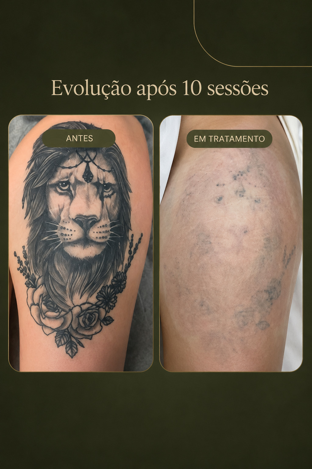 Antes e depois de remoção de tatuagem em tratamento