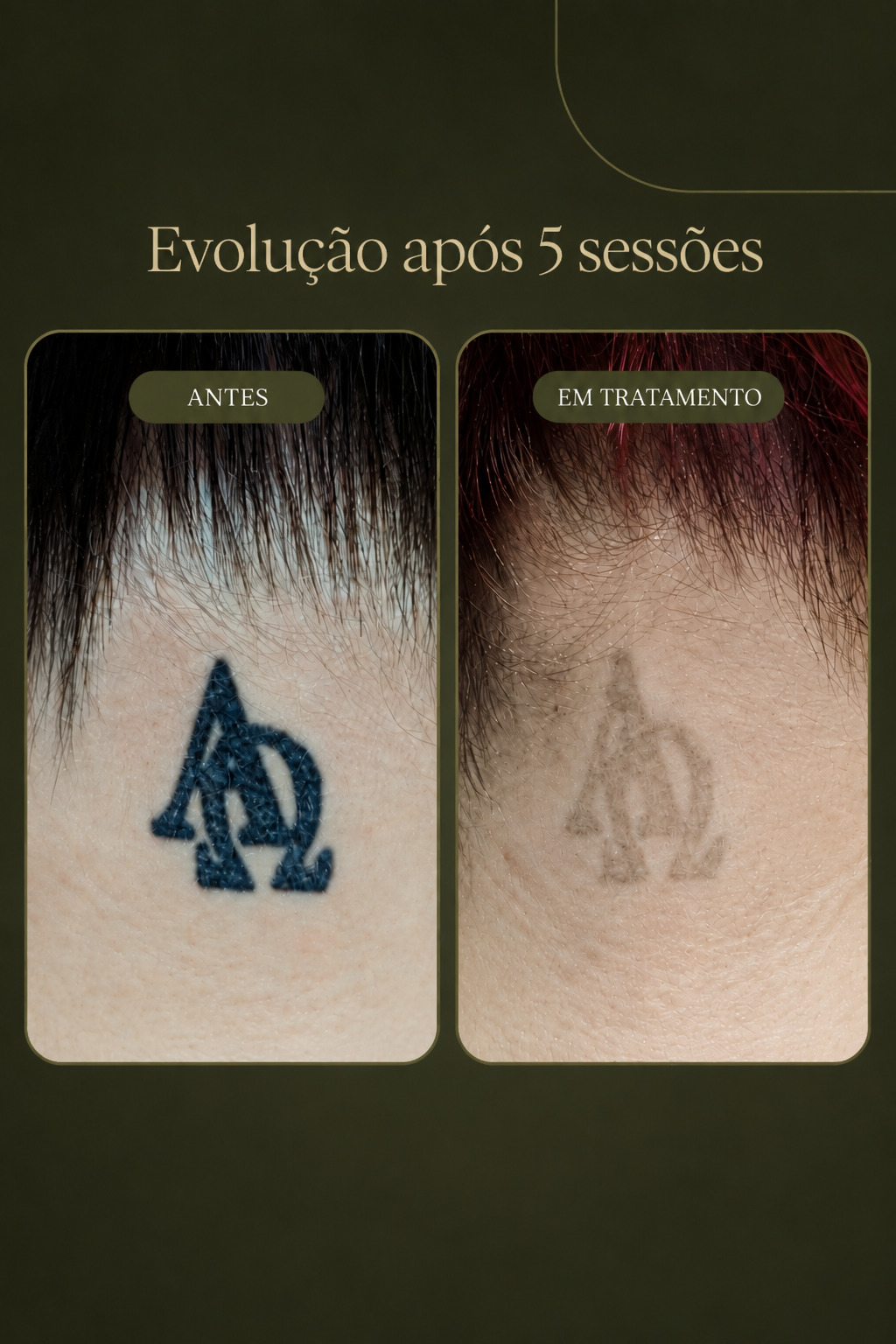 Resultado em tratamento de remoção de tatuagem