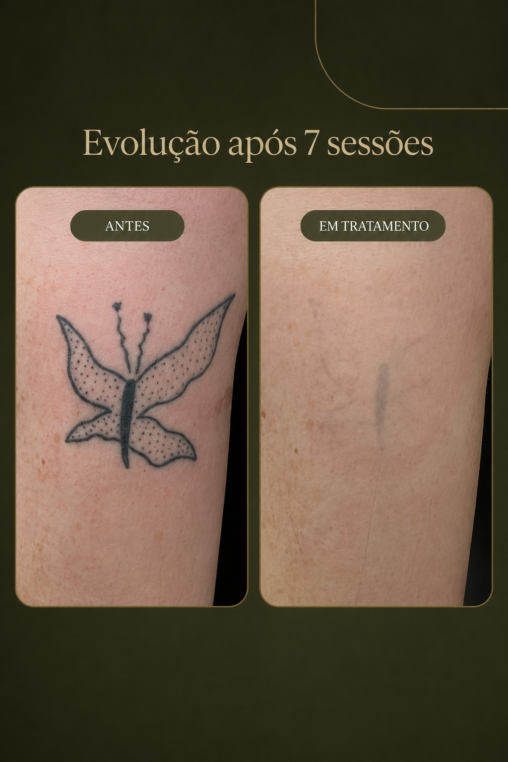 Evolução de clareamento de tatuagem a laser
